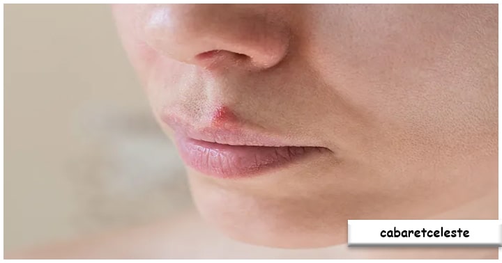 Penyebab Jerawat di Bibir