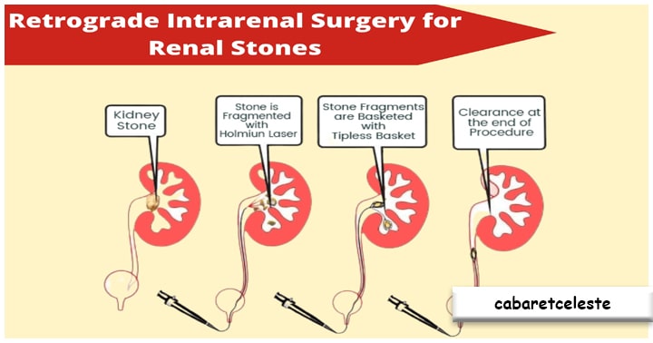 Retrograde Intrarenal Surgery
